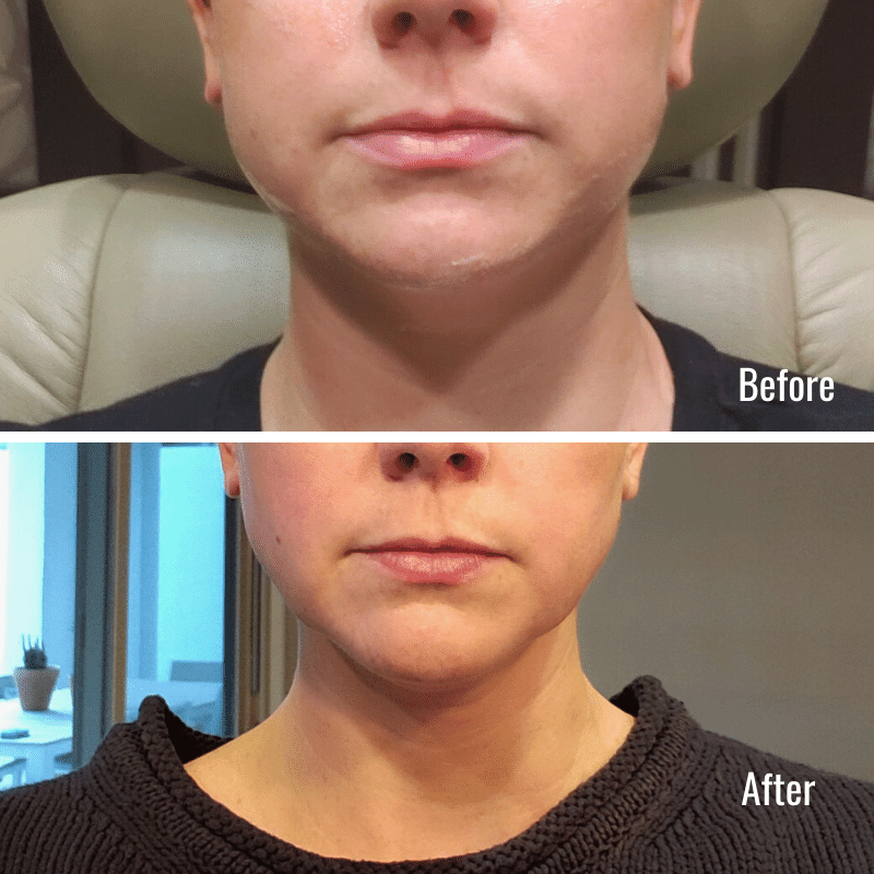 kybella before after cosmetic surgery med spa las vegas treatment face double chin antiaging